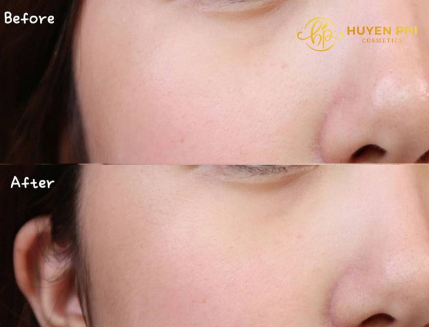 peel da và lăn kim cái nào tốt hơn