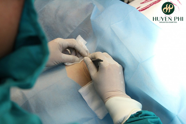 tự nhiên bị hôi nách