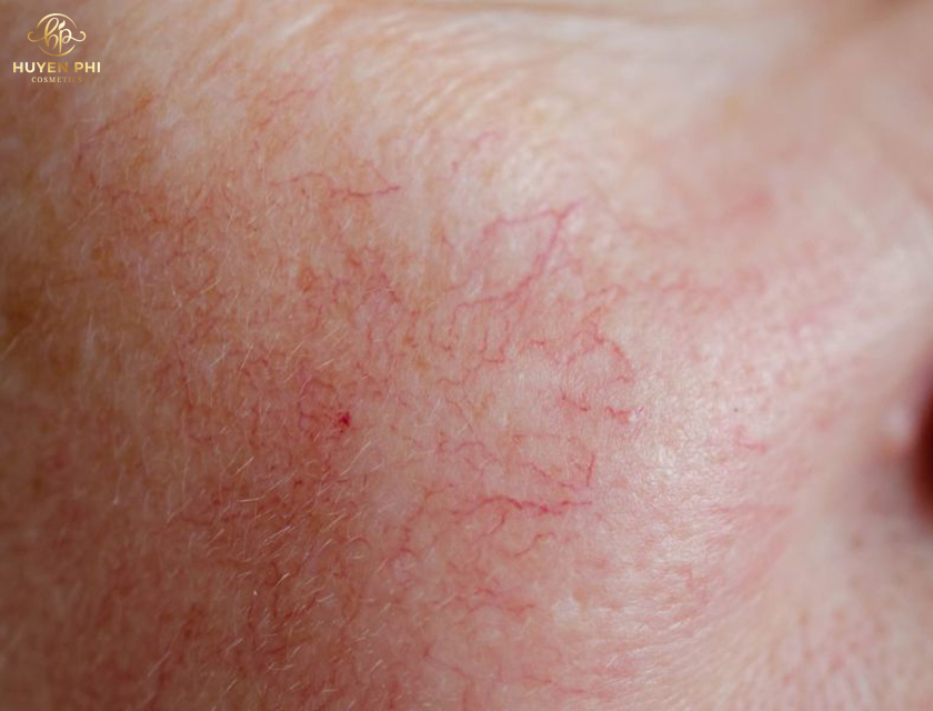 da mỏng có nên peel da