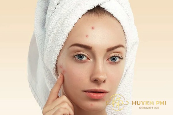 Mụn trứng cá xuất hiện ảnh hưởng tới thẩm mỹ của da mặt
