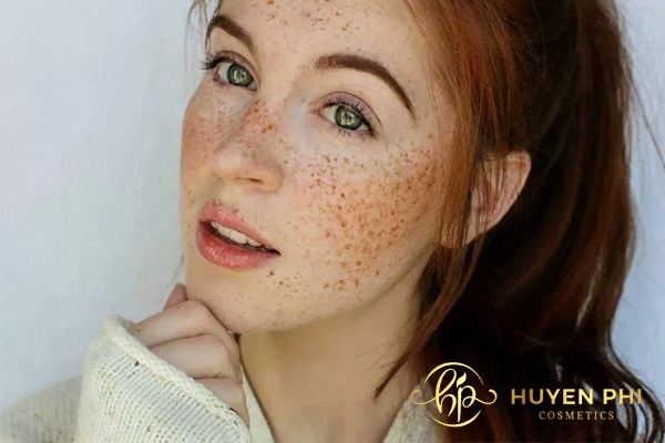 Da mặt sạm, nám khiến chị em tự ti về ngoại hình