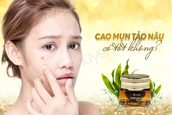 Sản phẩm cao mụn tảo nâu Huyền Phi có tốt không? Tìm hiểu ngay