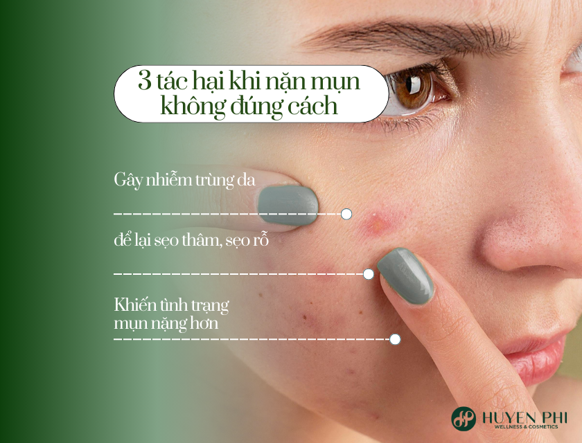 có nên nặn mụn trứng cá