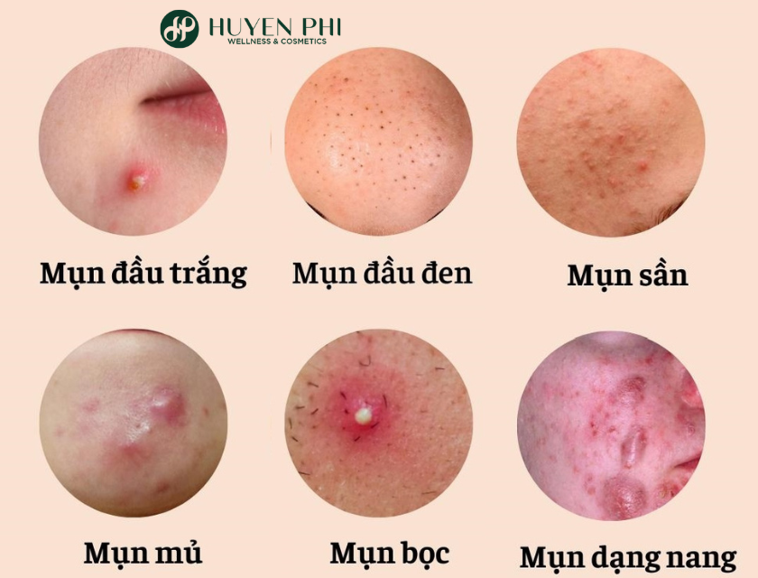 mụn trứng cá có nên nặn không