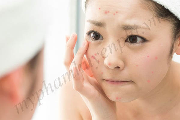 Dấu hiệu kích ứng khi lựa chọn sữa rửa mặt không phù hợp