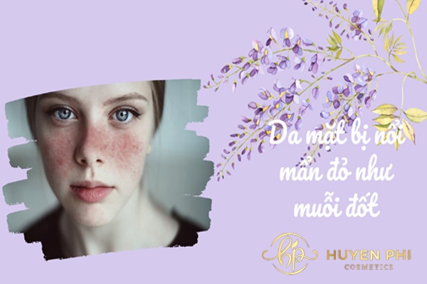 Da mặt bị nổi mẩn đỏ như muỗi đốt do nguyên nhân nào? Cần làm gì