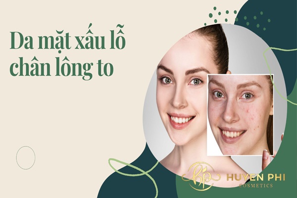 Tại sao da mặt xấu lỗ chân lông to? Cách khắc phục thế nào?