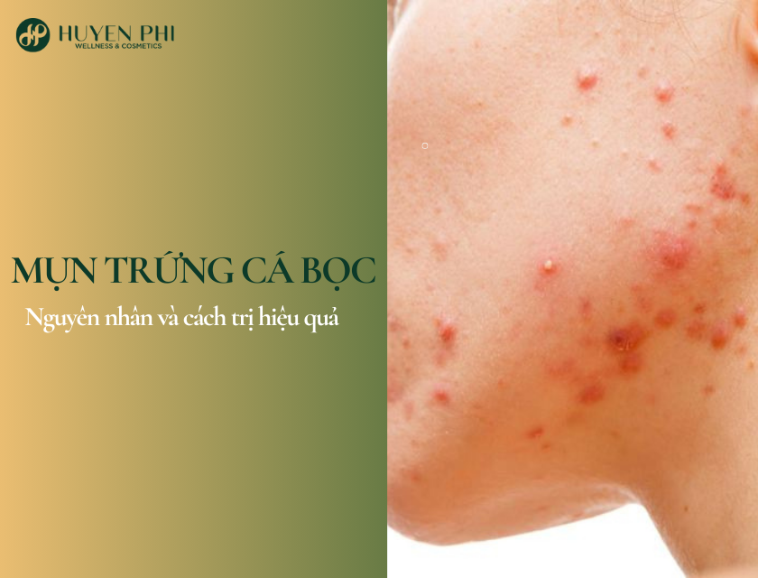 mụn trứng cá bọc