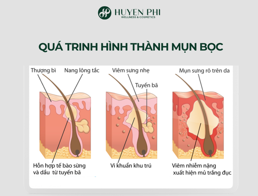 mụn bọc trứng cá
