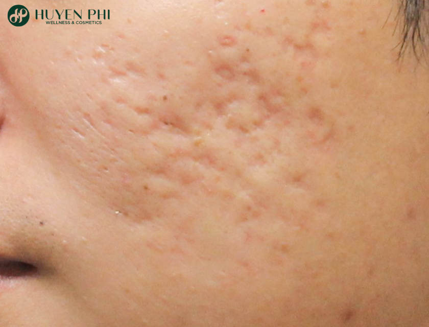 mụn trứng cá có tự hết không