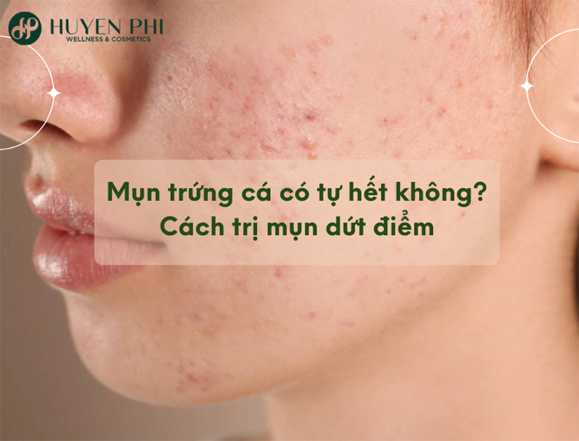 mụn trứng cá có tự hết không