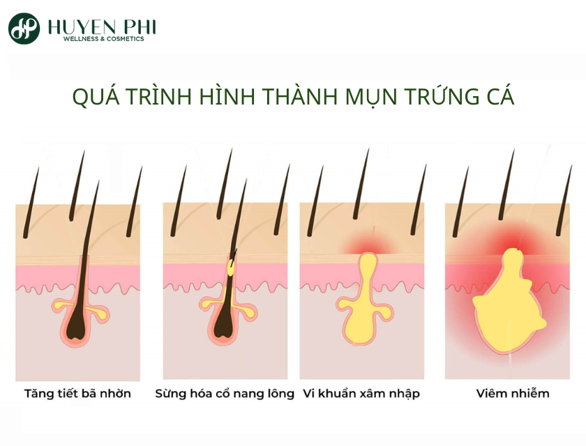 mụn trứng cá có tự khỏi không