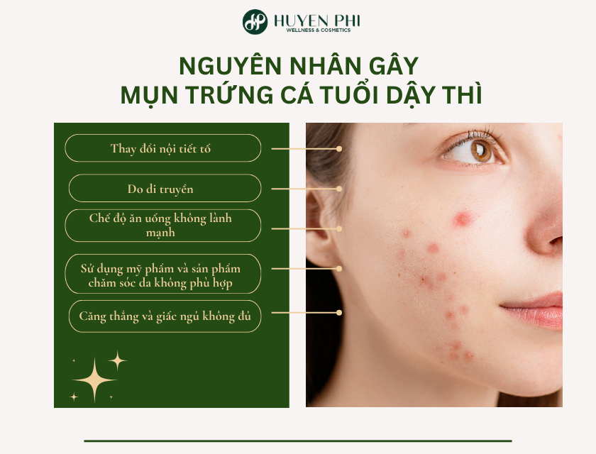 mụn trứng cá tuổi dậy thì