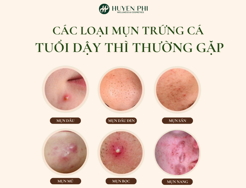 cách trị mụn trứng cá ở tuổi dậy thì