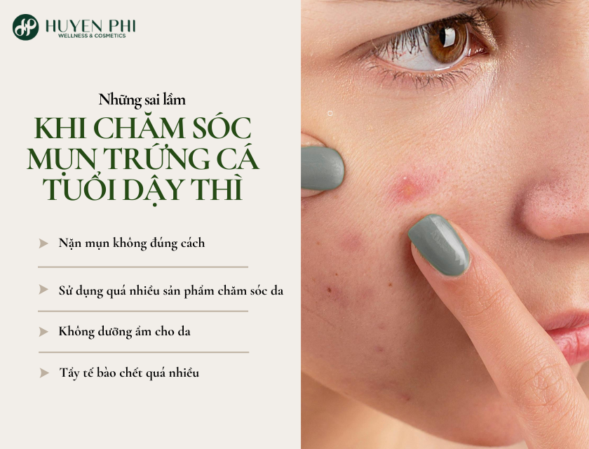 cách chữa mụn trứng cá tuổi dậy thì