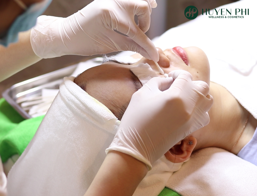 trị mụn trứng cá tuổi dậy thì