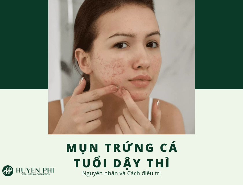 mụn trứng cá tuổi dậy thì