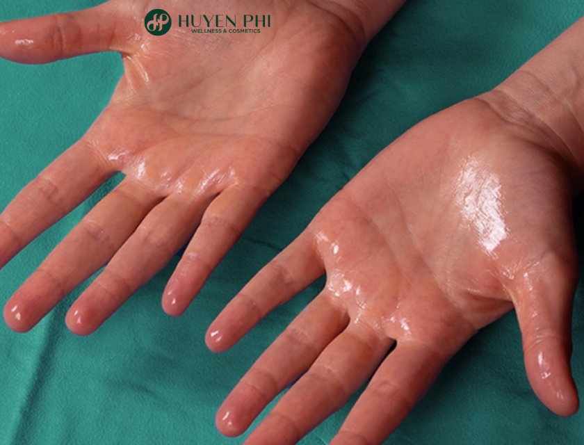 review cắt tuyến mồ hôi tay chân