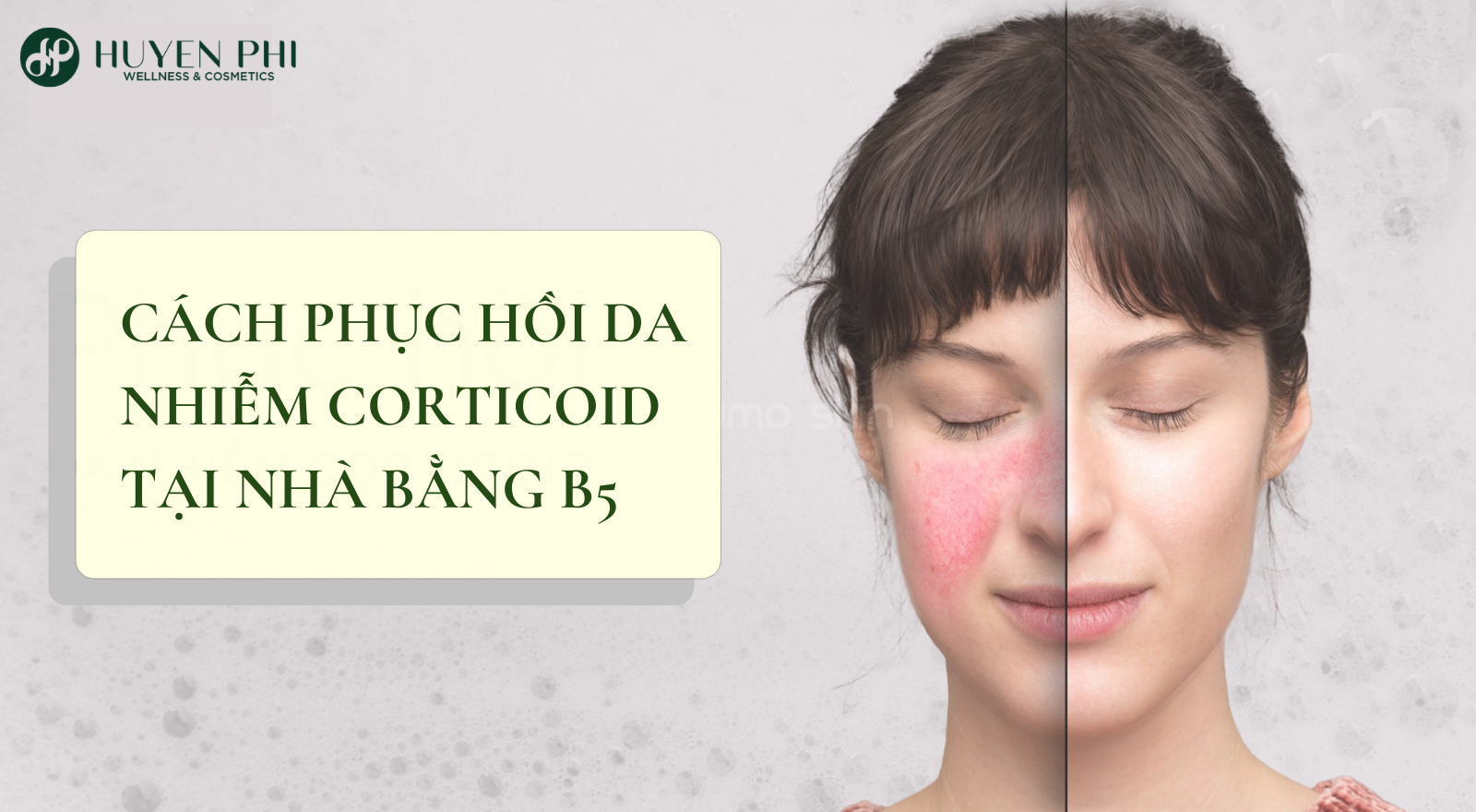 Cách sử dụng B5 phục hồi da nhiễm Corticoid hiệu quả