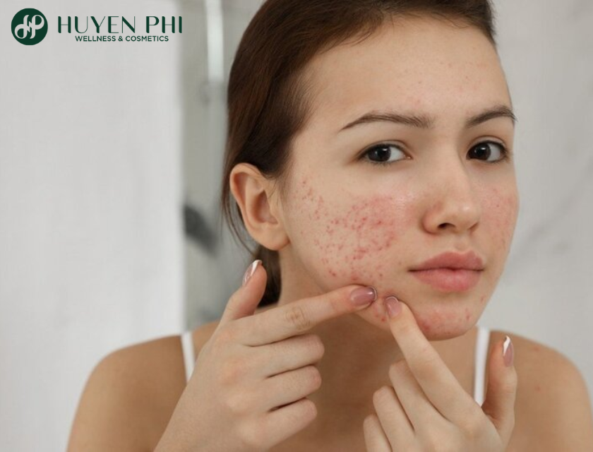 cách phục hồi da sau khi dùng kem trộn