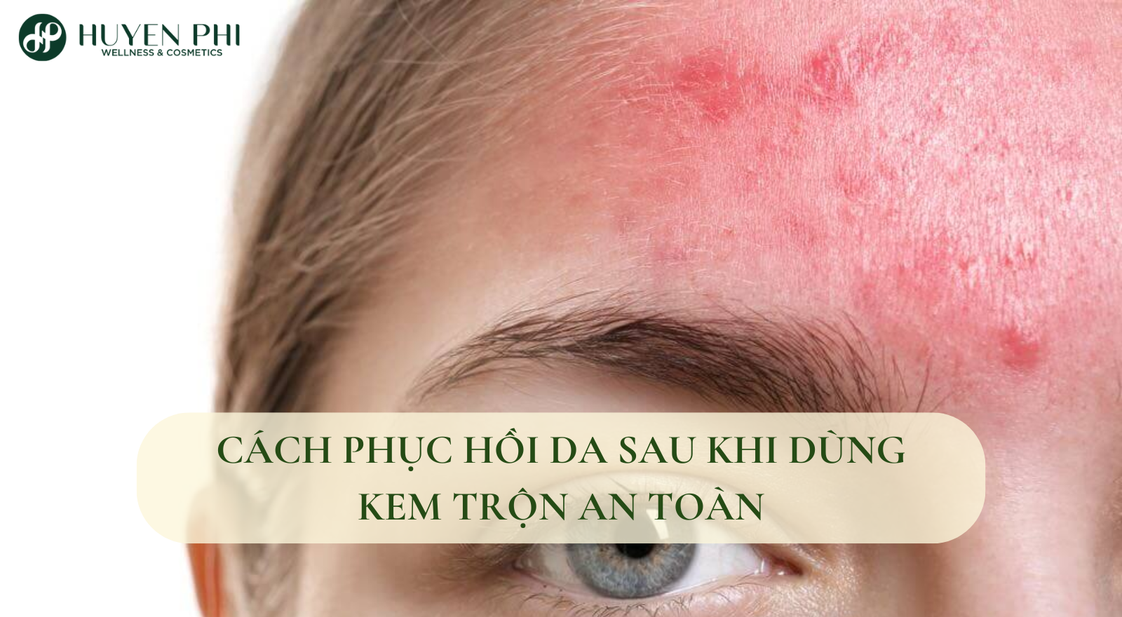 Cách phục hồi da sau khi dùng kem trộn an toàn tại nhà