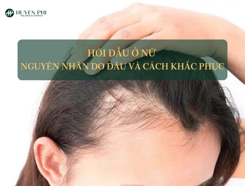hói đầu ở nữ