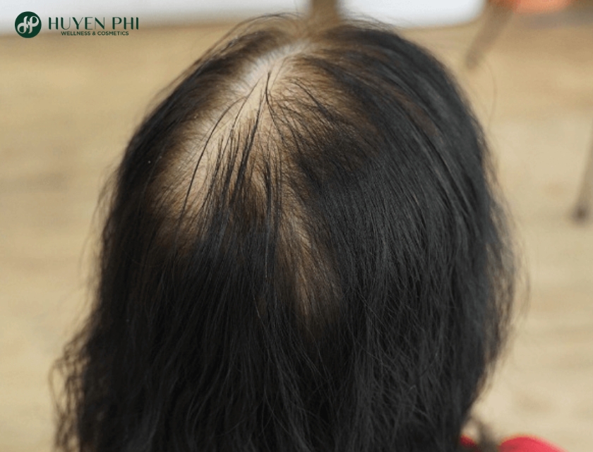 bị hói ở đỉnh đầu nữ