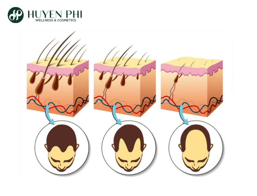nguyên nhân gây rụng tóc ở nam