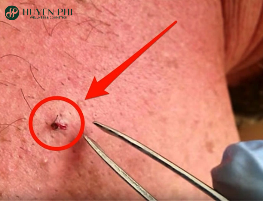 Cach Tri Long Moc Nguoc O Chan Tai Nha 3