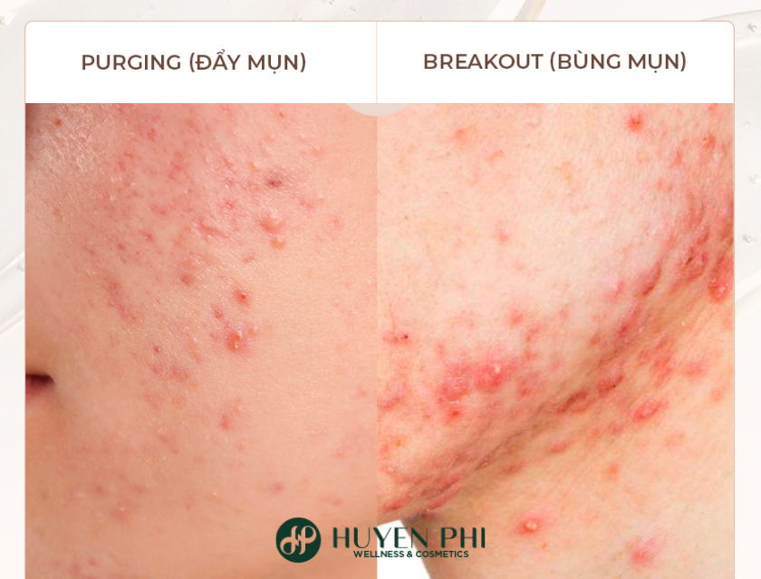 Dung Aha Co Bi Day Mun Khong 3