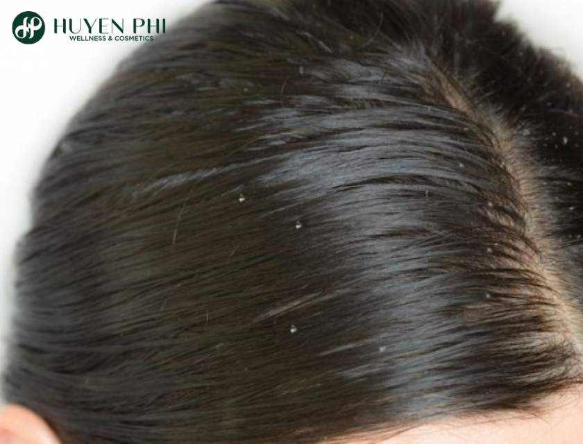 Goi Bo Ket Bi Bet Toc 2