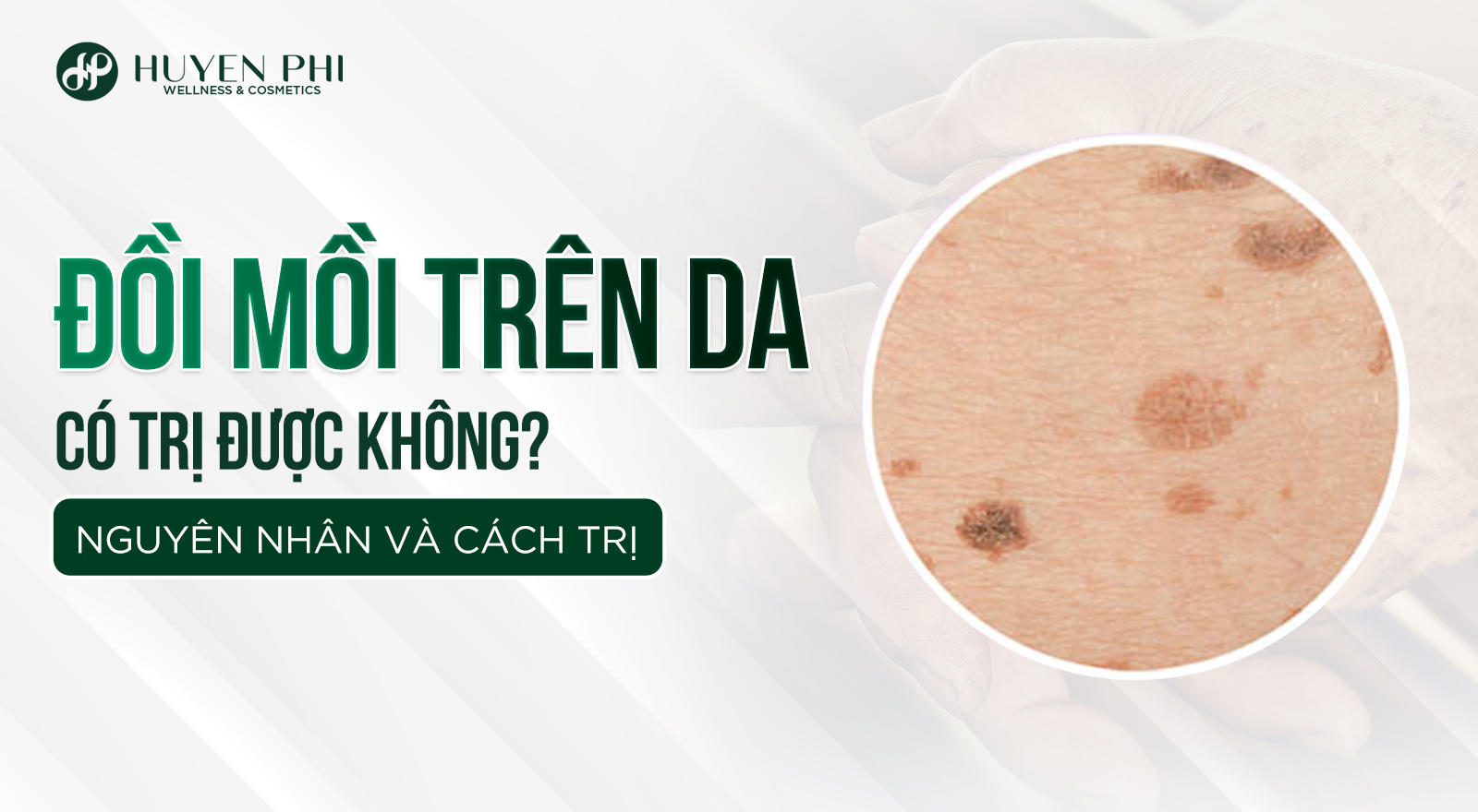 Đồi mồi trên da có trị được không? Nguyên nhân và cách trị