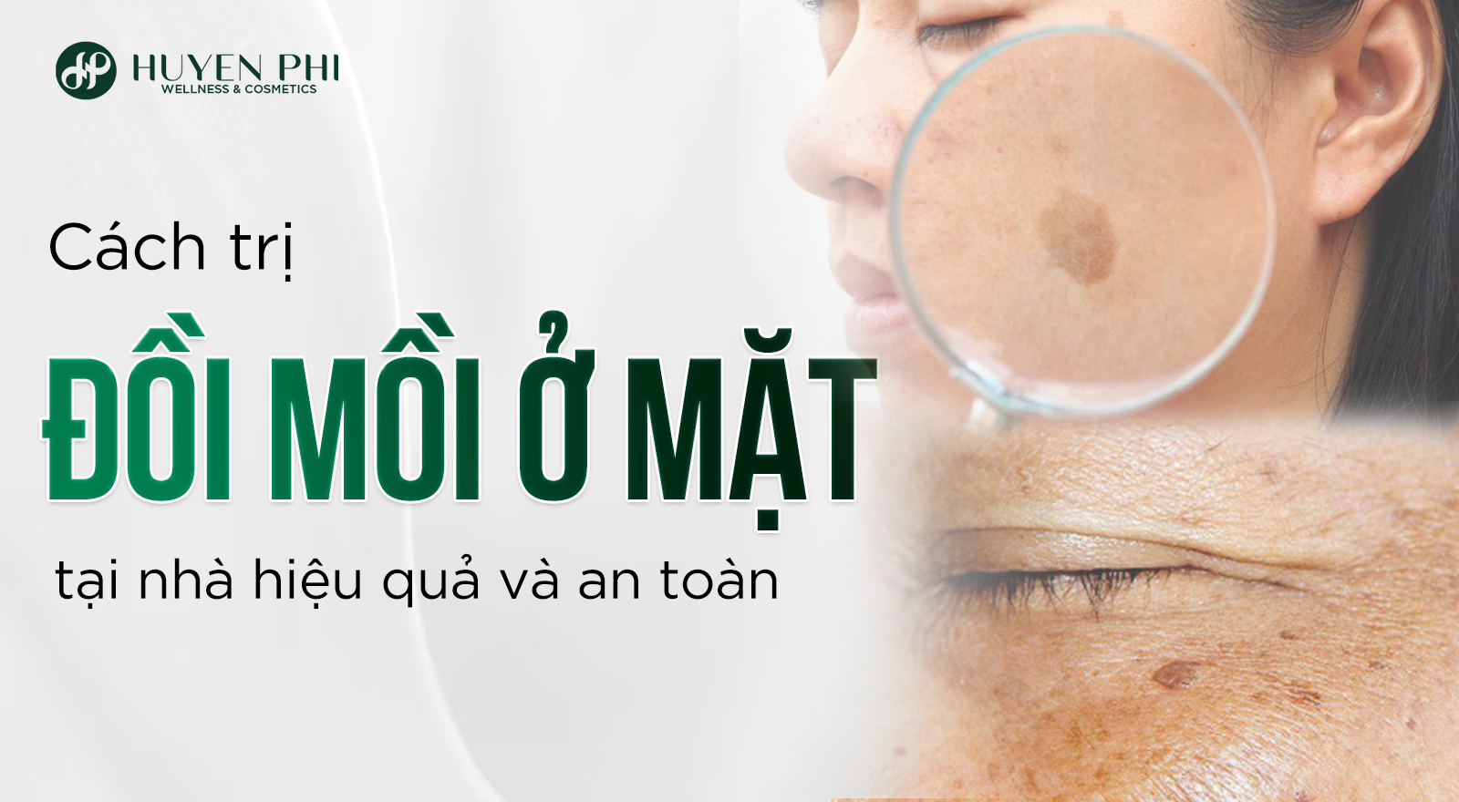 Cách trị đồi mồi ở mặt tại nhà hiệu quả và an toàn