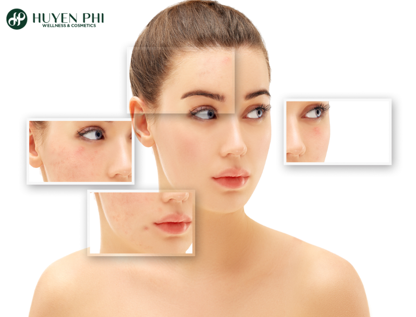 Azelaic Acid La Gi 2