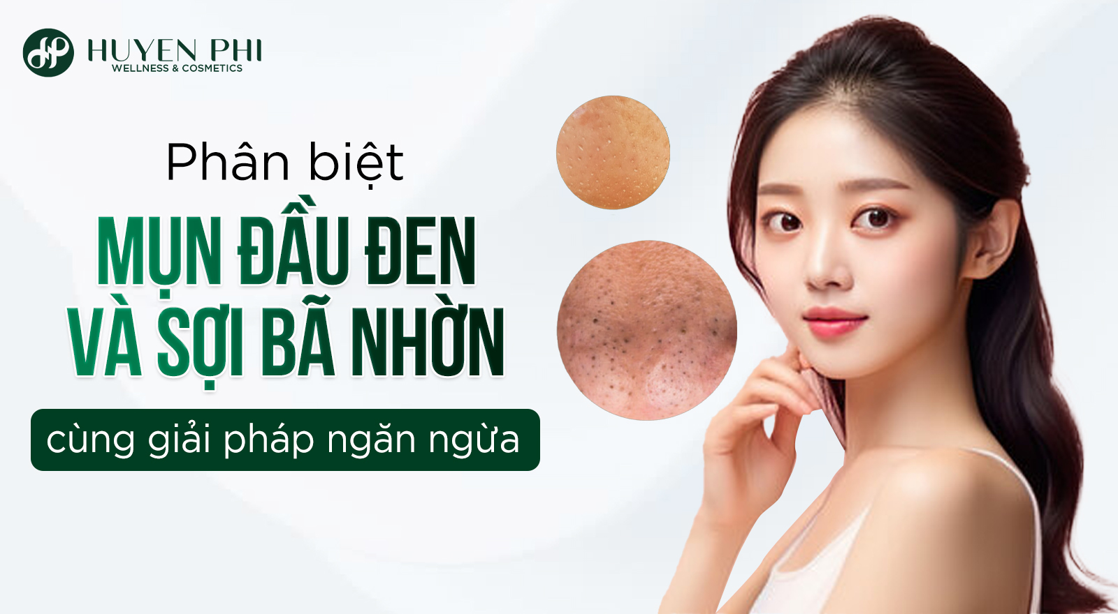Phân biệt mụn đầu đen và sợi bã nhờn cùng giải pháp ngăn ngừa