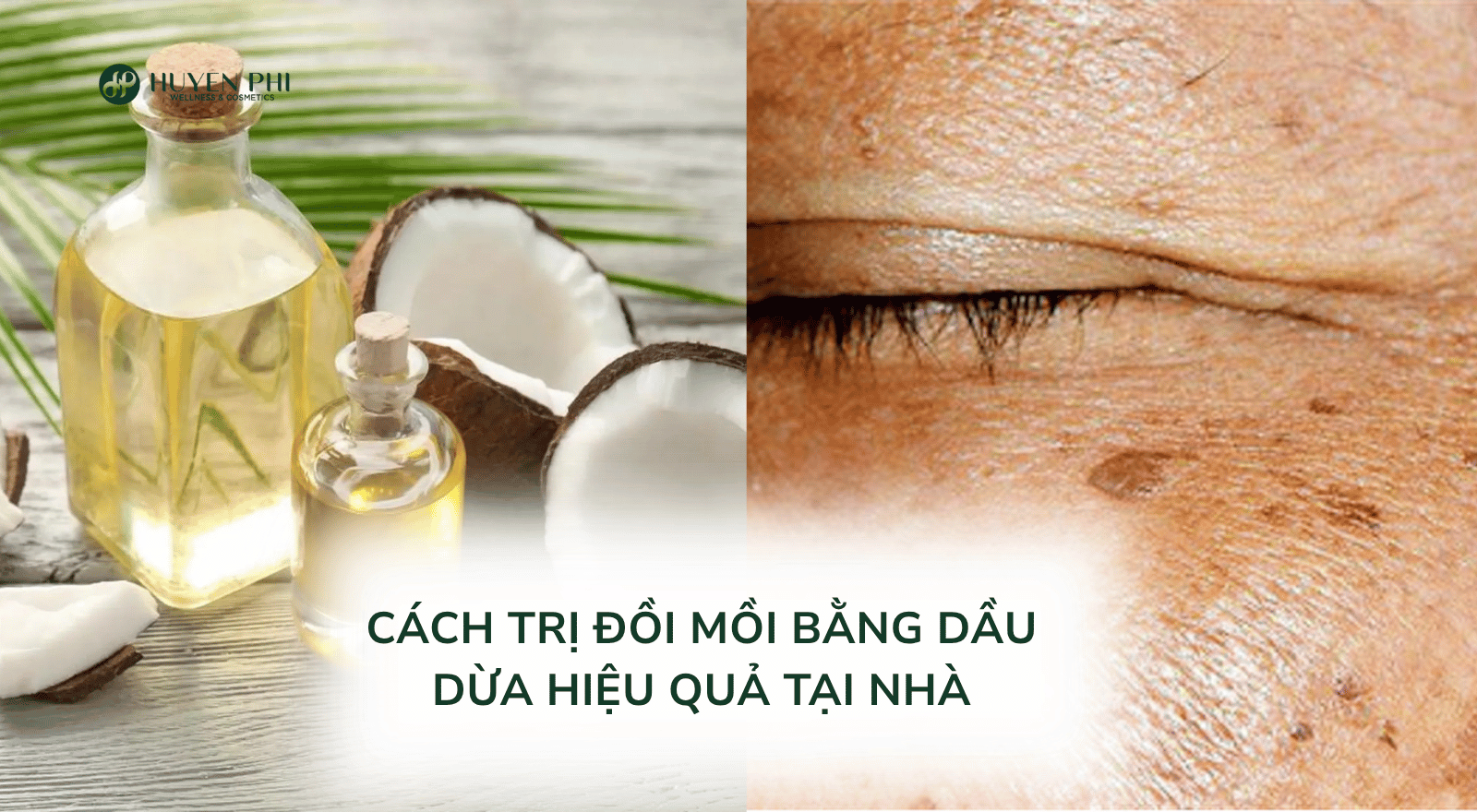 Trị đồi mồi bằng dầu dừa có hiệu quả không? Thực hiện thế nào