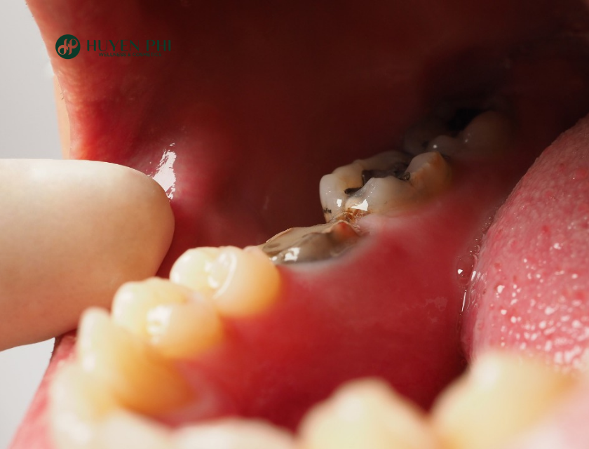 hôi miệng do sâu răng